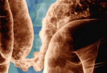 بیماری کرون