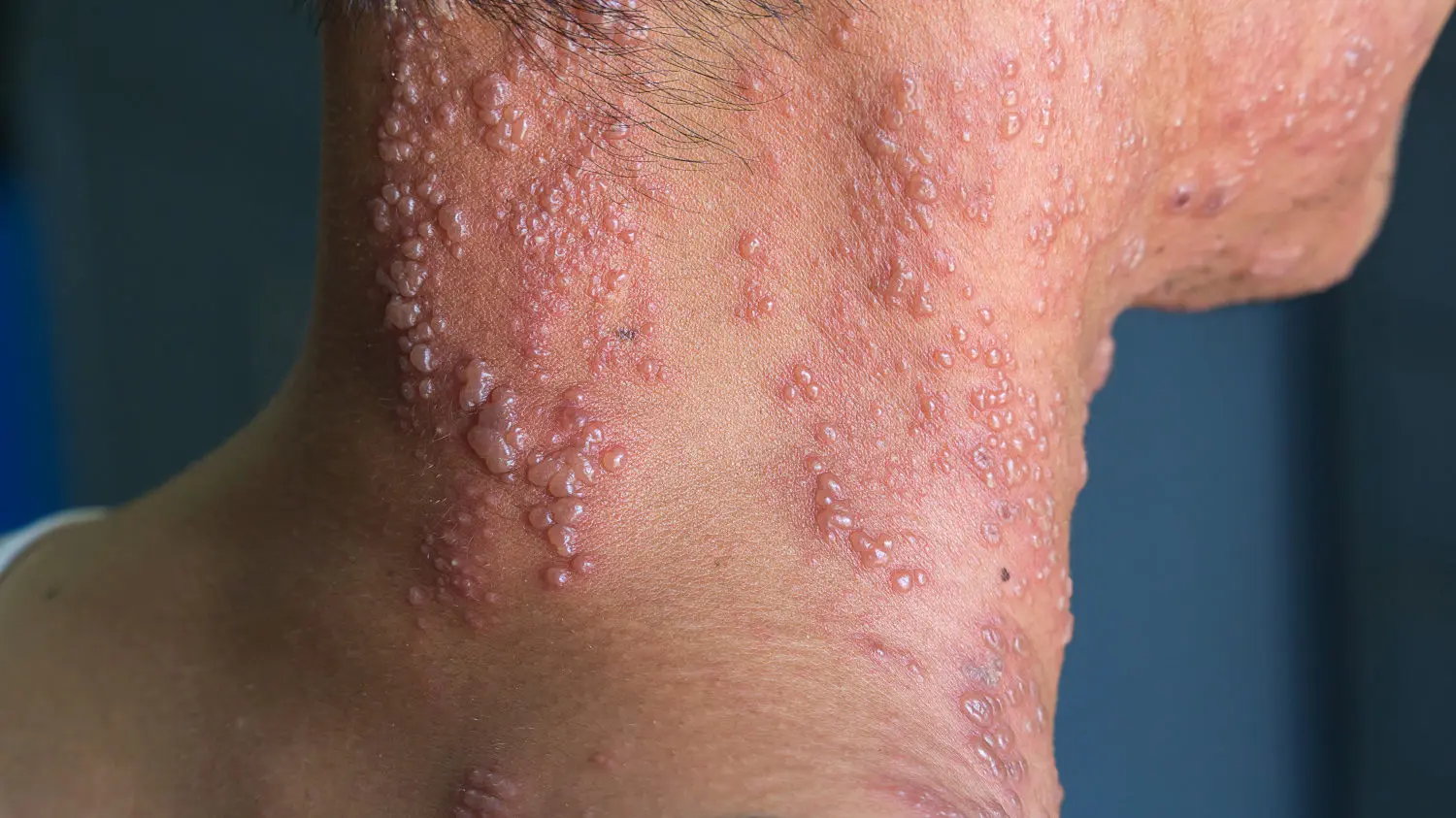 آیا زونا برای زن باردار خطرناک است؟