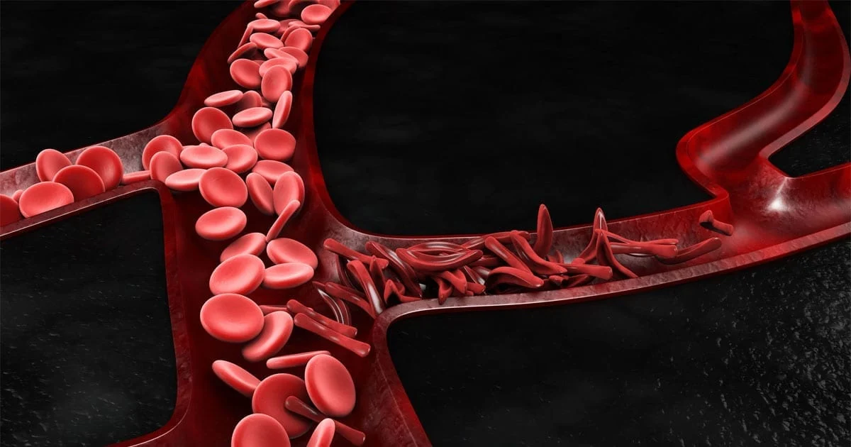کم خونی سلول داسی شکل